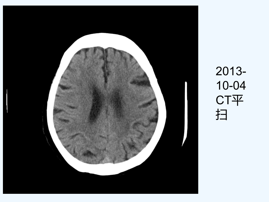 脑海绵状血管瘤影像学诊断与鉴别诊断课件.ppt_第3页