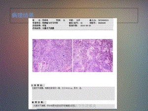 色素沉着绒毛结节性滑膜炎培训课件.ppt