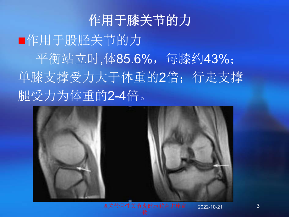 膝关节骨性关节炎健康教育讲座宣教培训课件.ppt_第3页