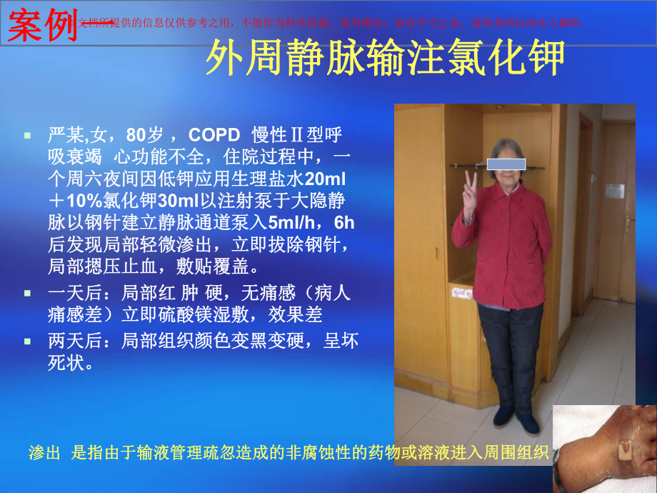 静脉血管评估与分级培训课件.ppt_第2页