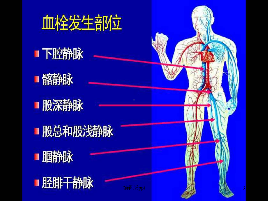 防治骨科领域中DVT的发生课件.ppt_第3页