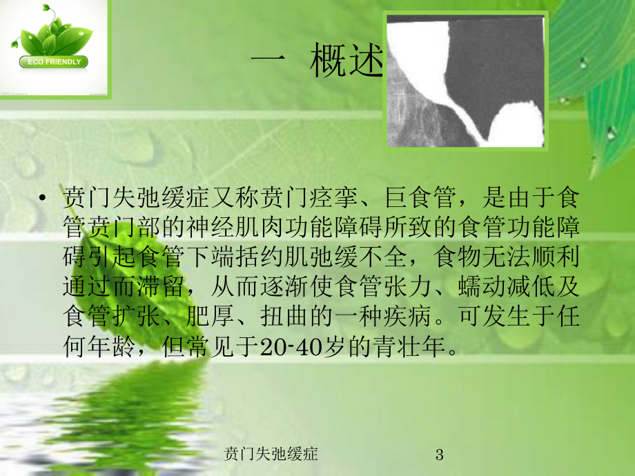 贲门失弛缓症培训课件.ppt_第3页