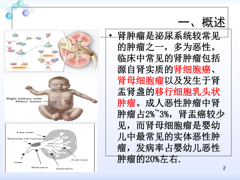 肾癌(护理查房)教学课件.ppt_第2页