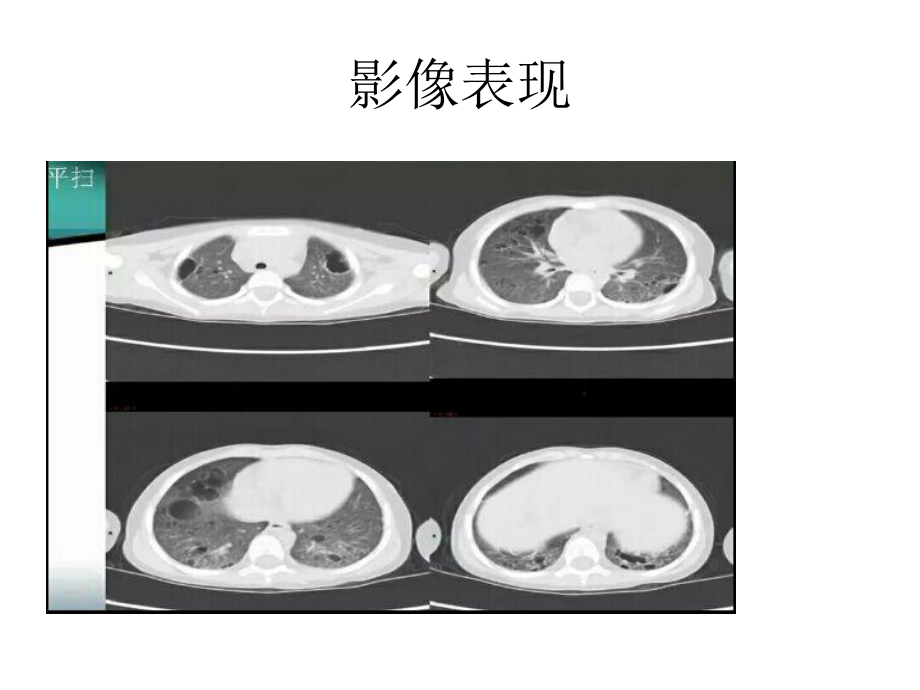 朗格罕斯细胞组织细胞增生症课件.ppt_第3页