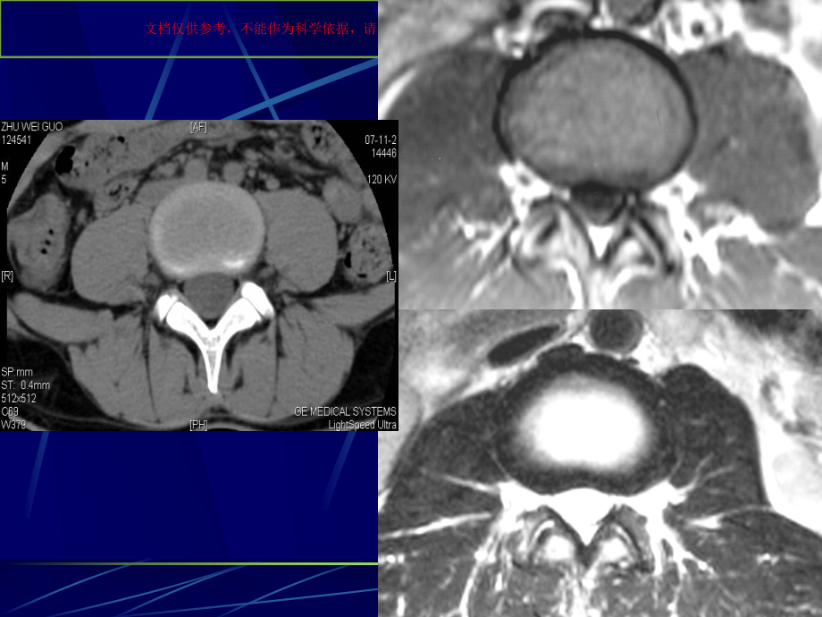 腰椎影像解剖及常见病变培训课件.ppt_第3页