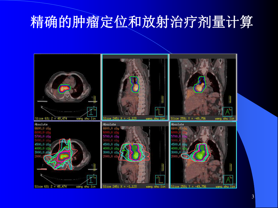 非小细胞肺癌放射治疗进展-非小细胞肺癌放射治疗课件.ppt_第3页