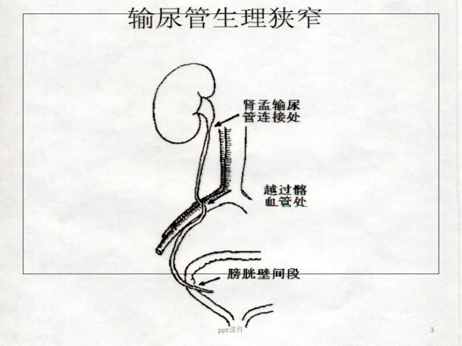 输尿管梗阻病人-课件.ppt_第3页