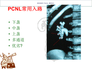 肾上盏穿刺入路在PCN术的应用课件2.ppt