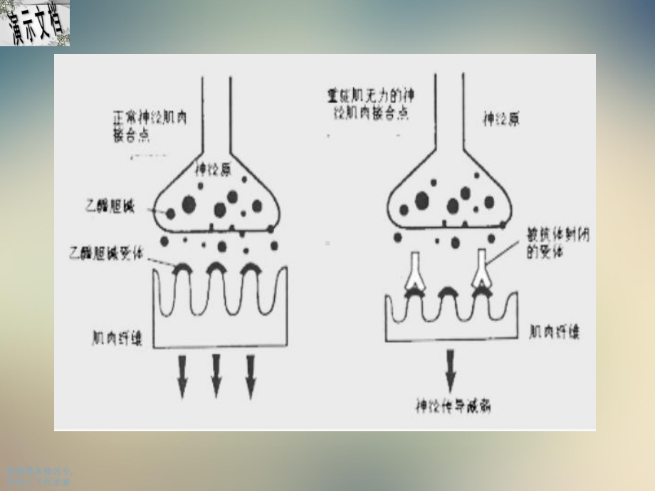 重症肌无力的临床表现及诊断培训课件.ppt_第3页