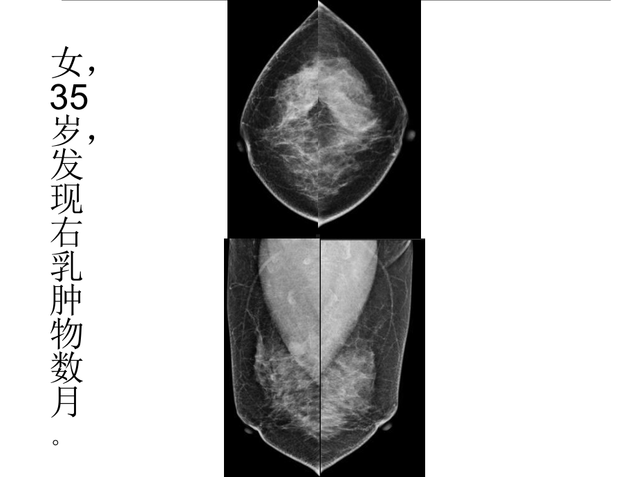 乳腺癌的x线诊断及鉴别诊断课件.ppt_第2页