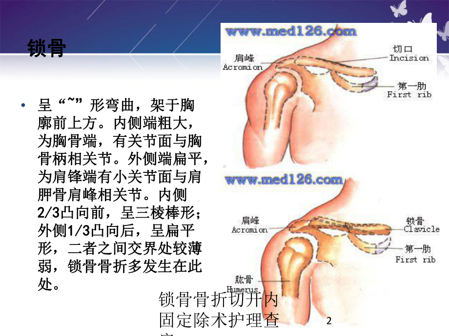 锁骨骨折切开内固定除术护理查房培训课件.ppt_第2页