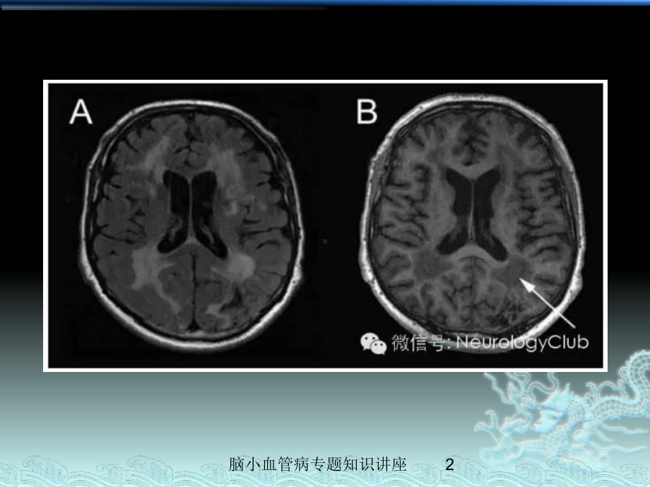 脑小血管病专题知识讲座培训课件.ppt_第2页