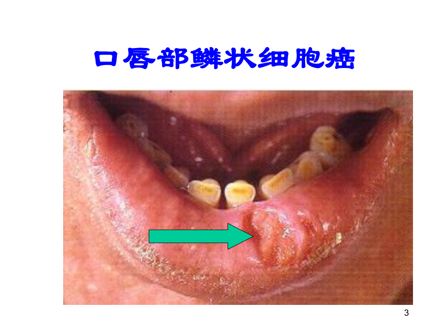 肿瘤图片课件.ppt_第3页