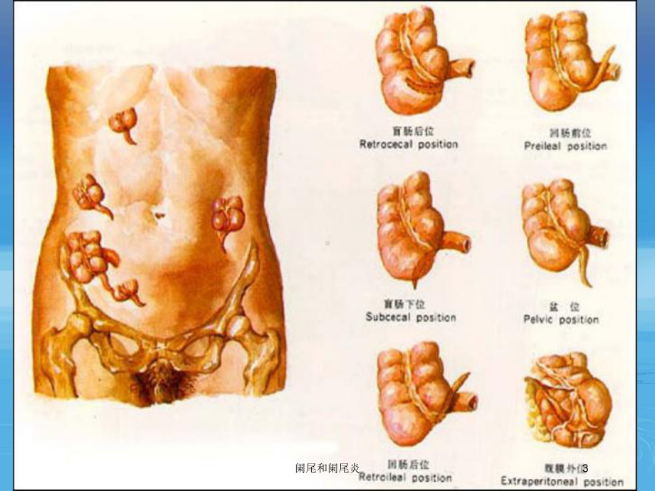 阑尾和阑尾炎培训课件.ppt_第3页