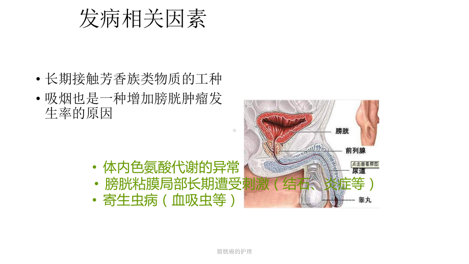 膀胱癌的护理课件.ppt_第3页