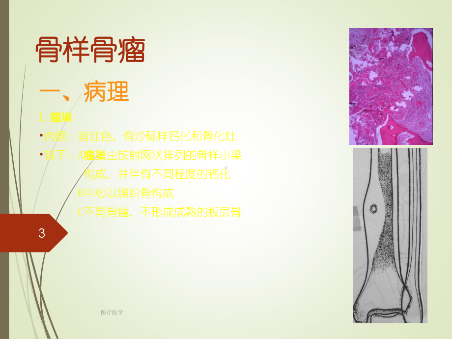 良性骨肿瘤(行业运用)课件.ppt_第3页