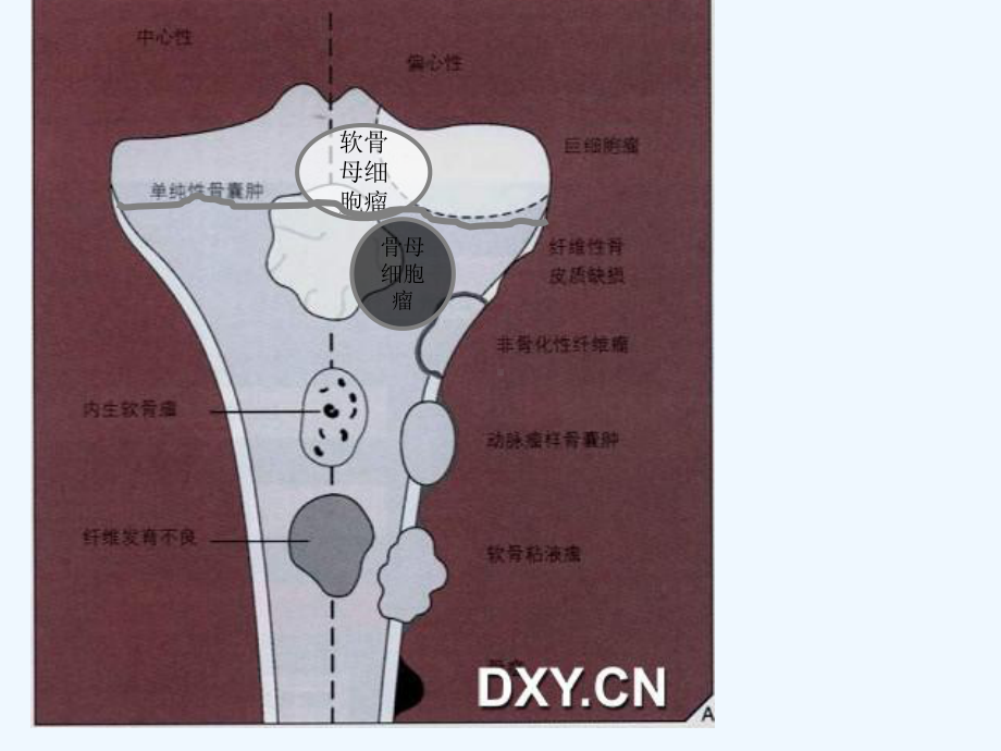 长骨偏心膨胀性病变的影像特征课件.ppt_第3页