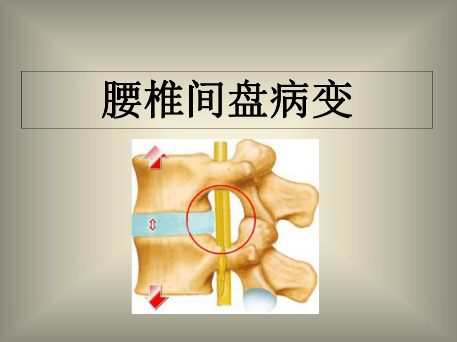 腰椎间盘病变的分型及影像学诊断优质课件.ppt_第1页