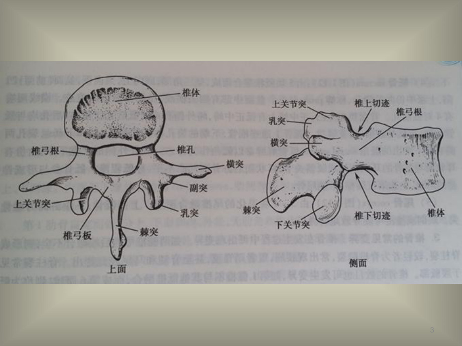 腰椎间盘病变的分型及影像学诊断优质课件.ppt_第3页