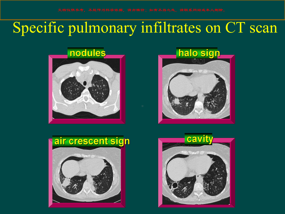 肺隐球菌感染的影像学改变培训课件.ppt_第2页