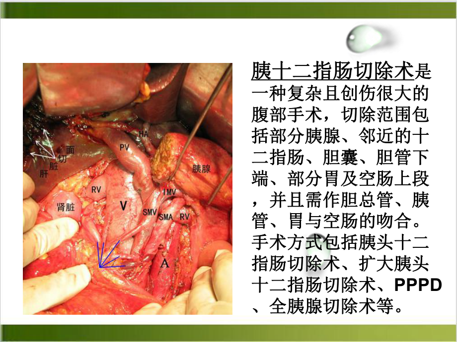 胰十二指肠切除术示范课件.ppt_第3页