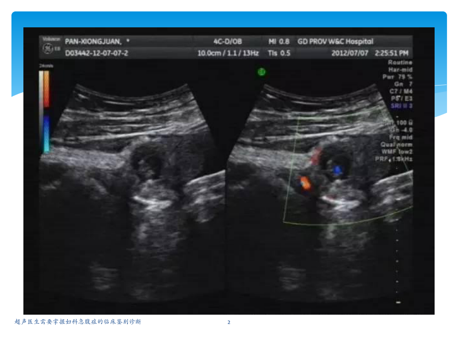超声医生需要掌握妇科急腹症的临床鉴别诊断课件.pptx_第2页