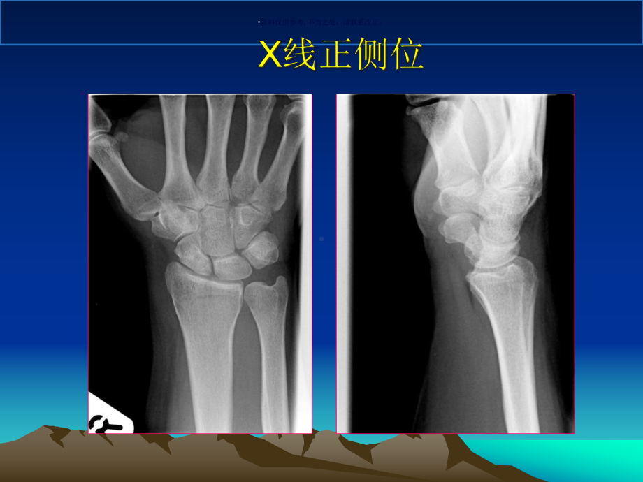 腕关节MR医学宣教课件.ppt_第1页