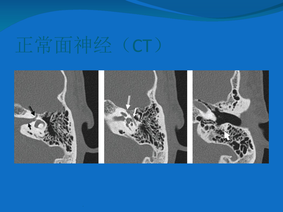 面神经解剖及病变课件.ppt_第3页