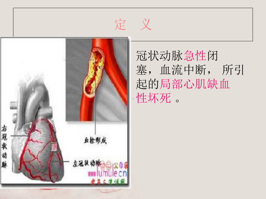 急性心肌梗死护理查房--课件.ppt_第3页