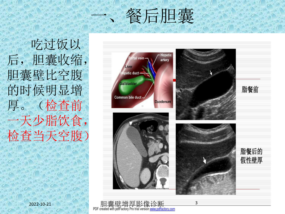 胆囊壁增厚影像诊断培训课件.ppt_第3页