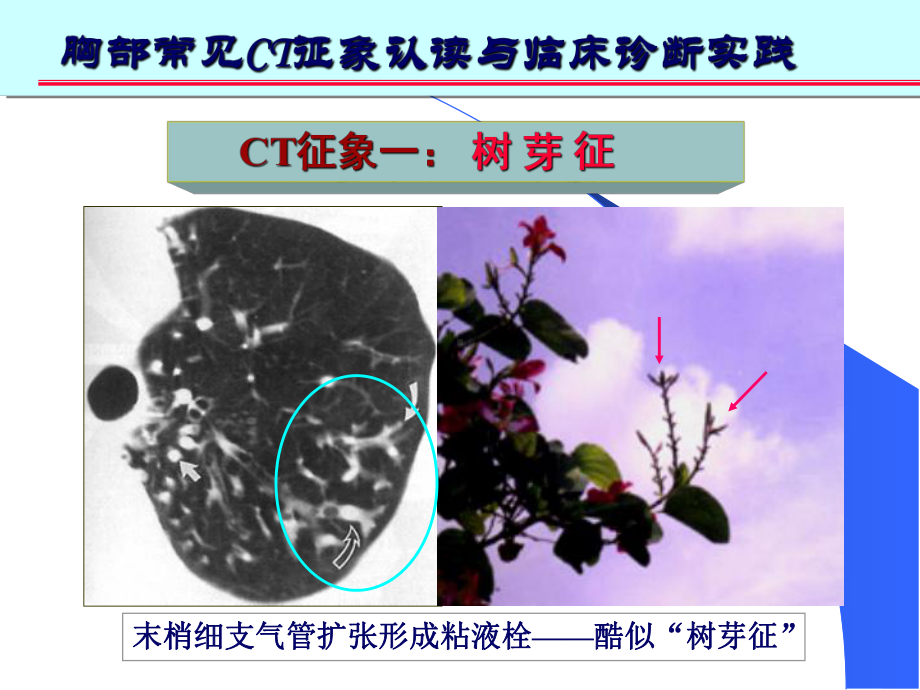 胸部常见CT十大征象的诊疗和应用培训课件.ppt_第3页