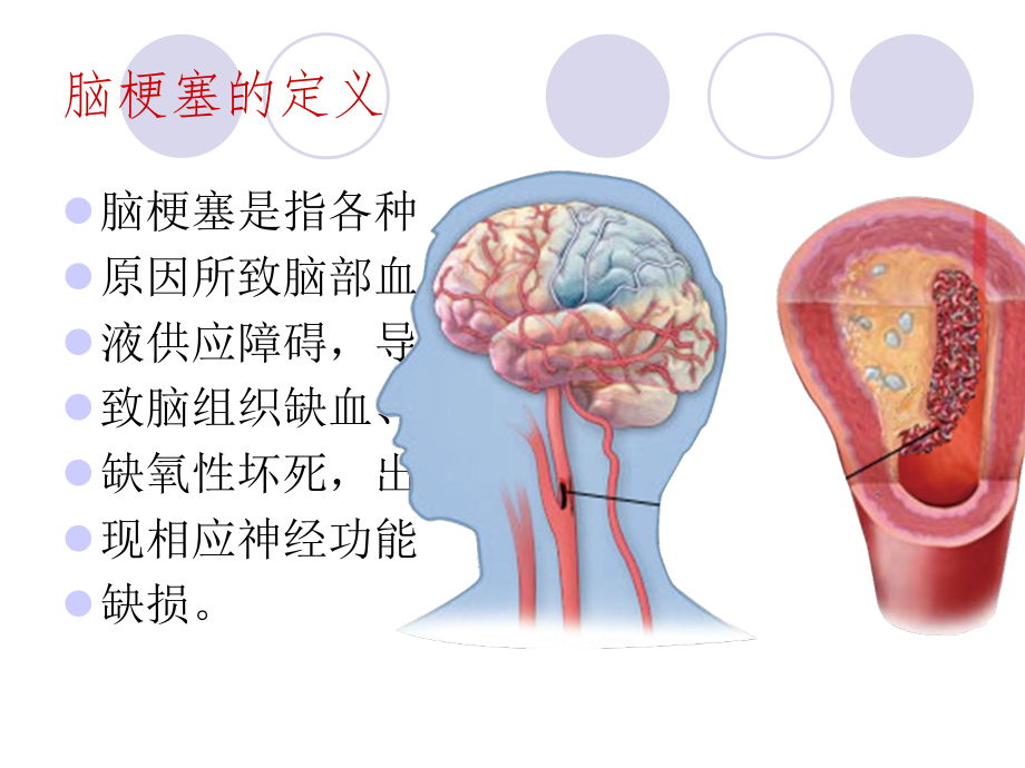 脑梗塞护理病例讨论课件.pptx_第3页