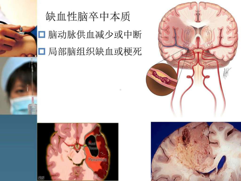 脑梗死动脉溶栓和取栓的护理主题讲座课件.ppt_第2页