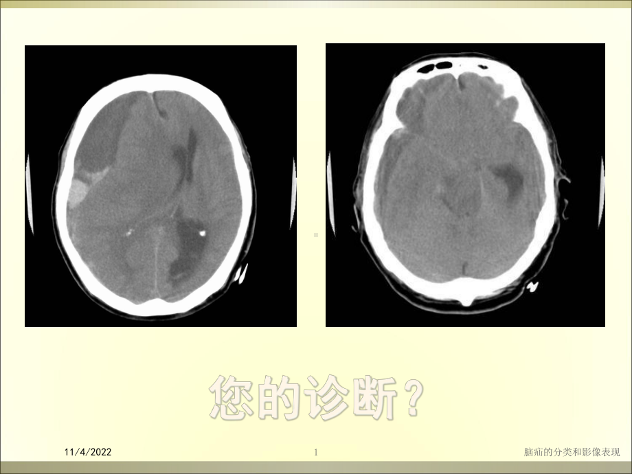 脑疝的分类和影像表现培训课件.ppt_第1页