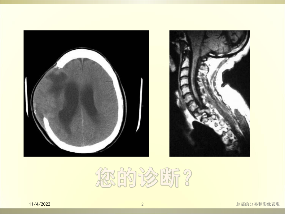 脑疝的分类和影像表现培训课件.ppt_第2页