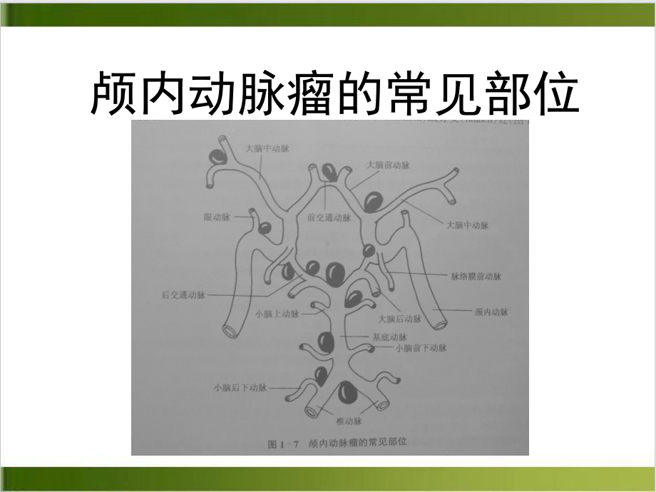 颅内动脉瘤的血管内治疗课件-2.ppt_第3页