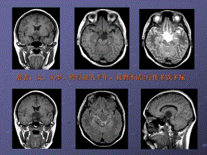 颅咽管瘤的影像诊断课件.pptx