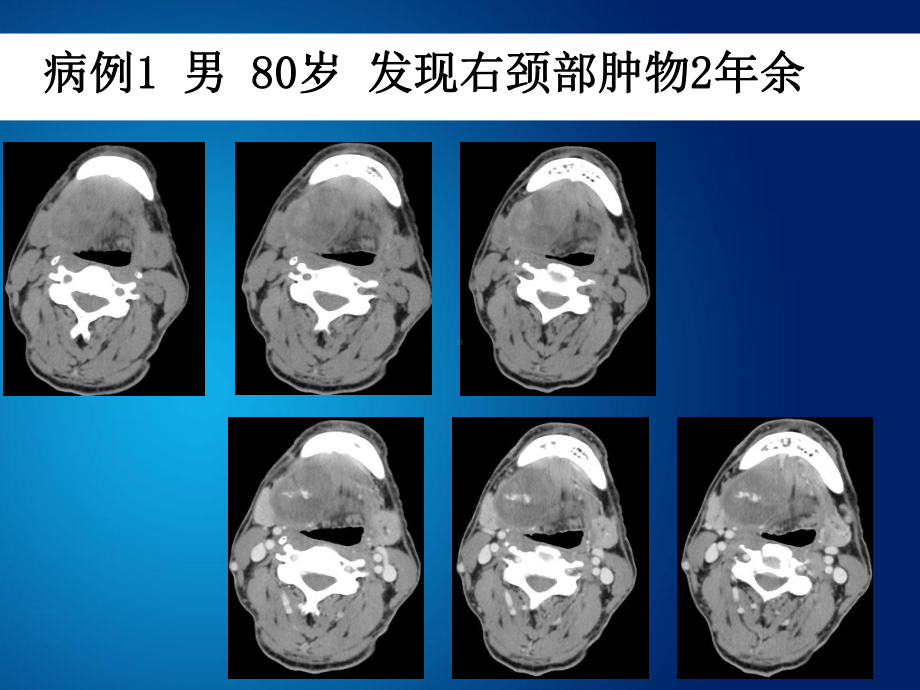 胃神经鞘瘤的诊疗和鉴别诊疗培训课件.ppt_第2页