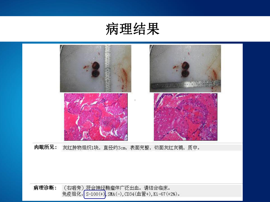 胃神经鞘瘤的诊疗和鉴别诊疗培训课件.ppt_第3页