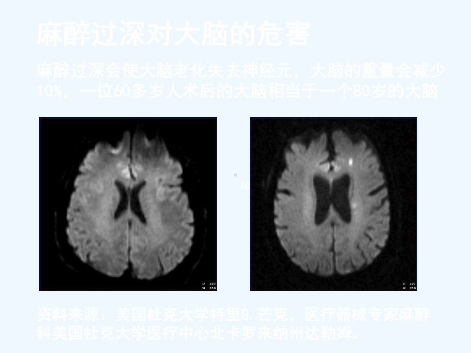 脑电麻醉深度参数及临床运用课件.pptx_第2页