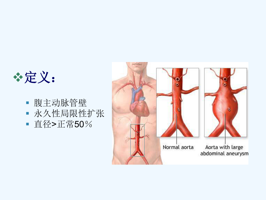 腔内介入治疗腹主动脉瘤课件.ppt_第3页