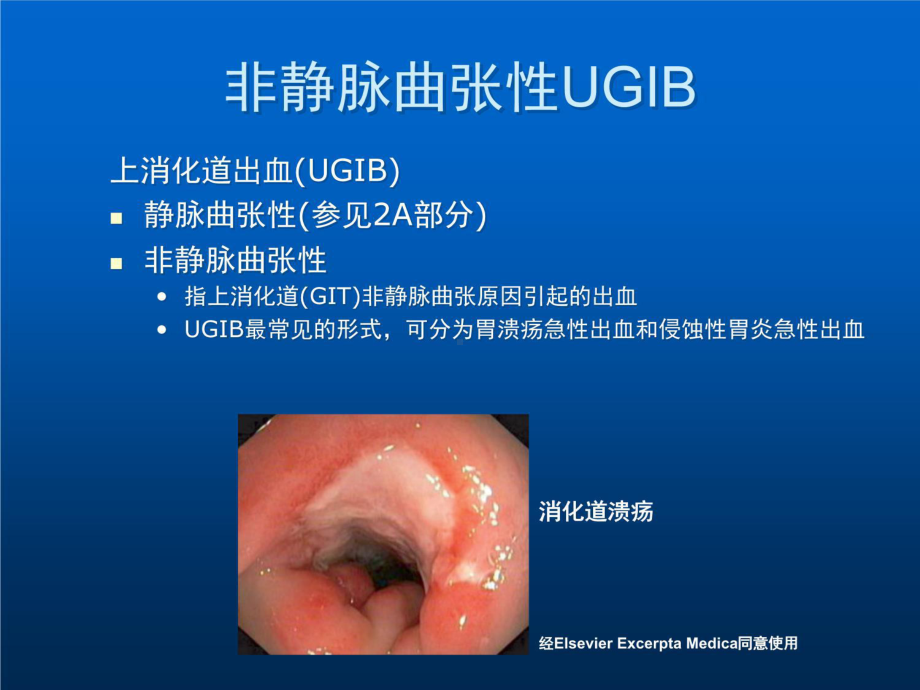 非静脉曲张性上消化道出血课件-2.ppt_第2页