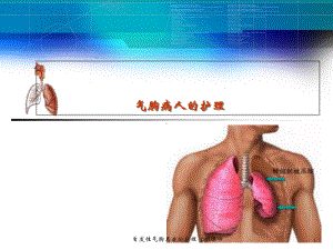 自发性气胸患者的护理-课件.ppt