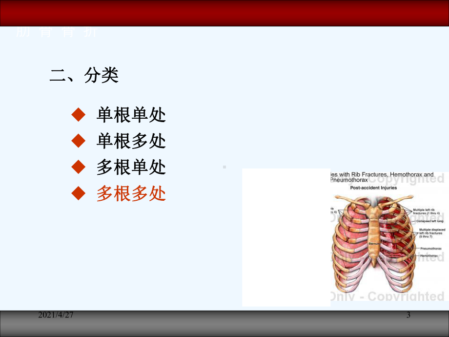 胸部损伤病人课件.ppt_第3页