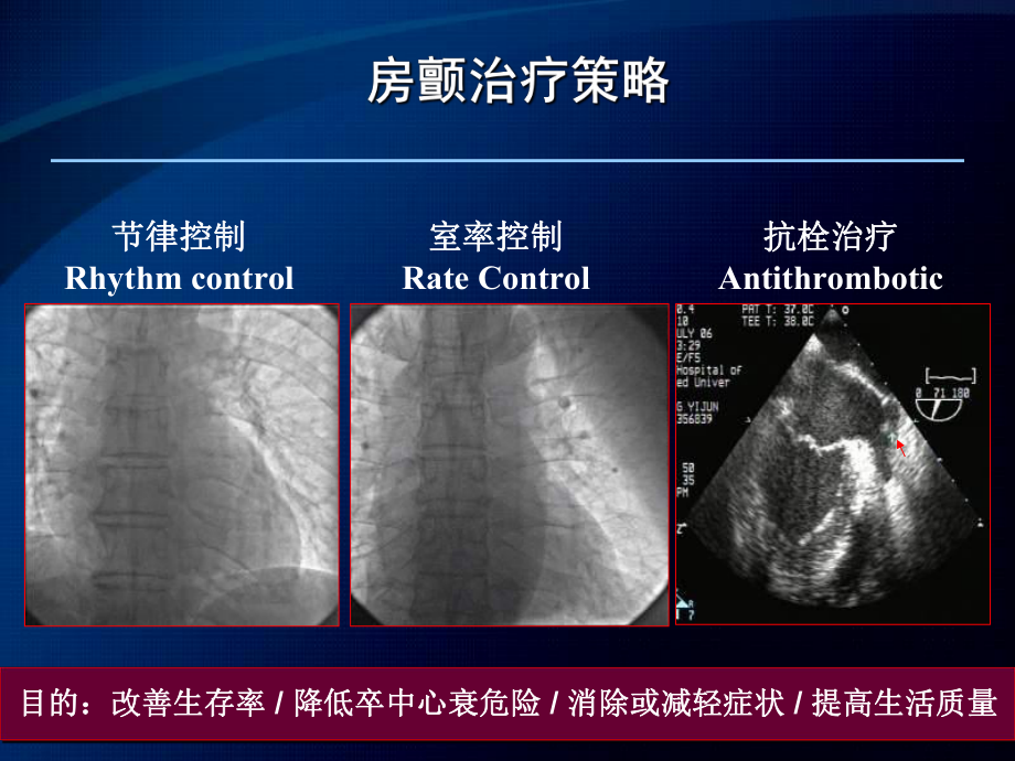 房颤治疗策略节律-vs-频率控制-争论带来的误区课件.ppt_第2页