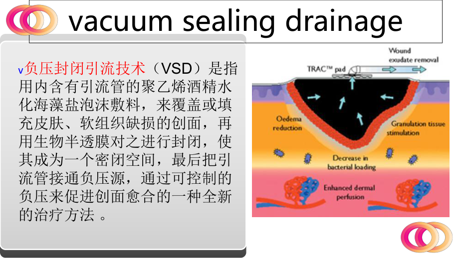 负压引流封闭技术VSD护理查房课件.ppt_第2页