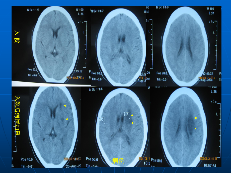 脑分水岭梗死-课件.ppt_第3页