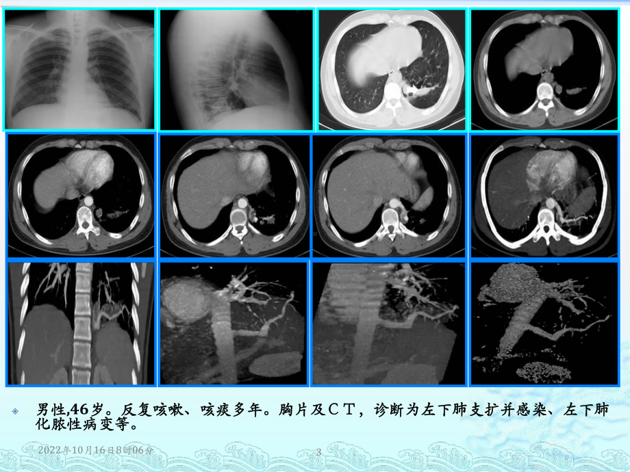 肺隔离症诊断之影像与病理参考课件.ppt_第3页