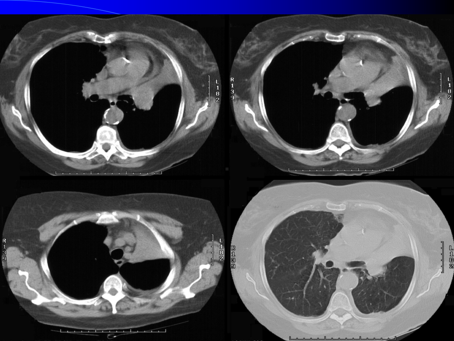 胸部病变基本CT表现课件.ppt_第3页