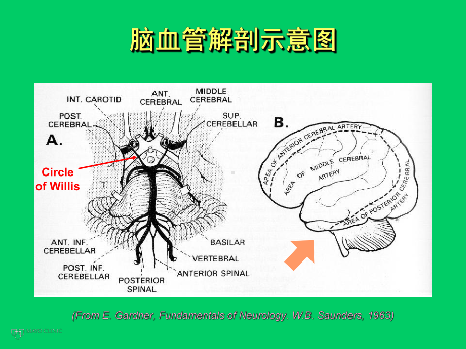 尼膜同在出血性脑血管病中的临床应用课件.ppt_第2页